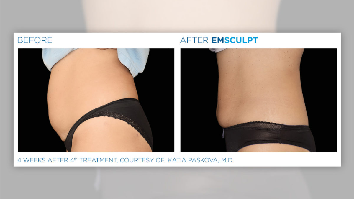 The Exclusive EMSCULPT® Provider in the Upper Valley