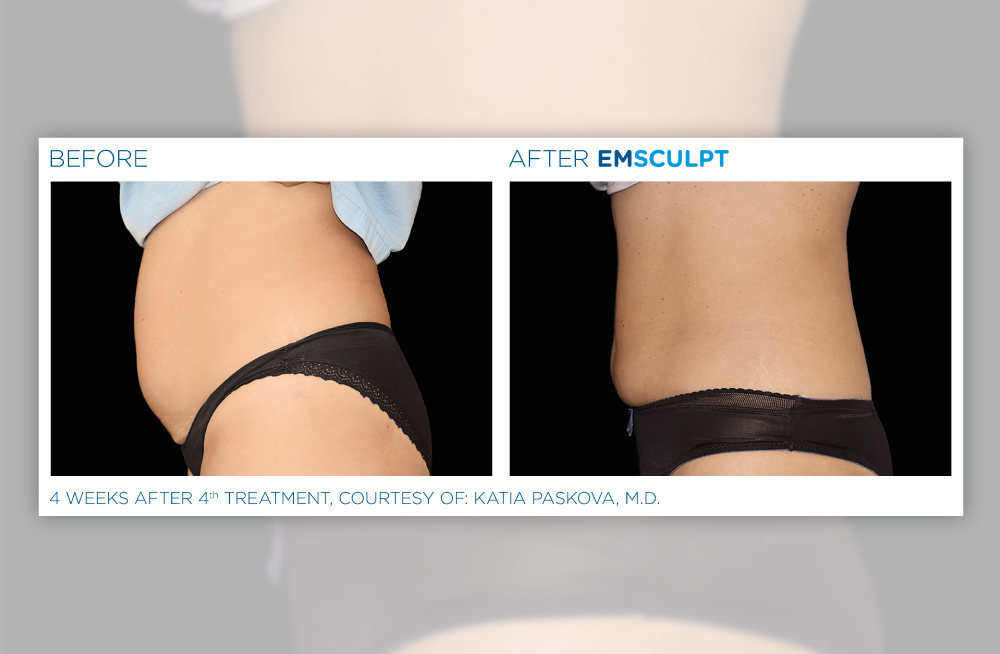 The Exclusive EMSCULPT® Provider in the Upper Valley - Peraza