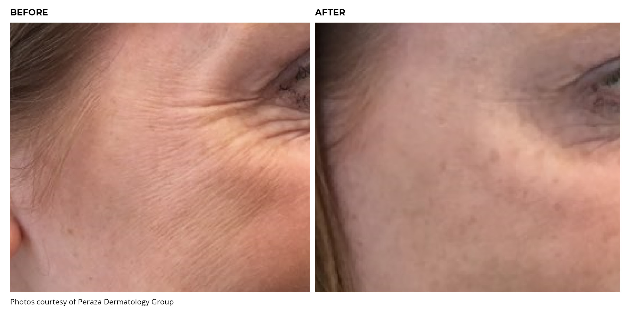 BOTOX Cosmetic Crow's Feet Lines