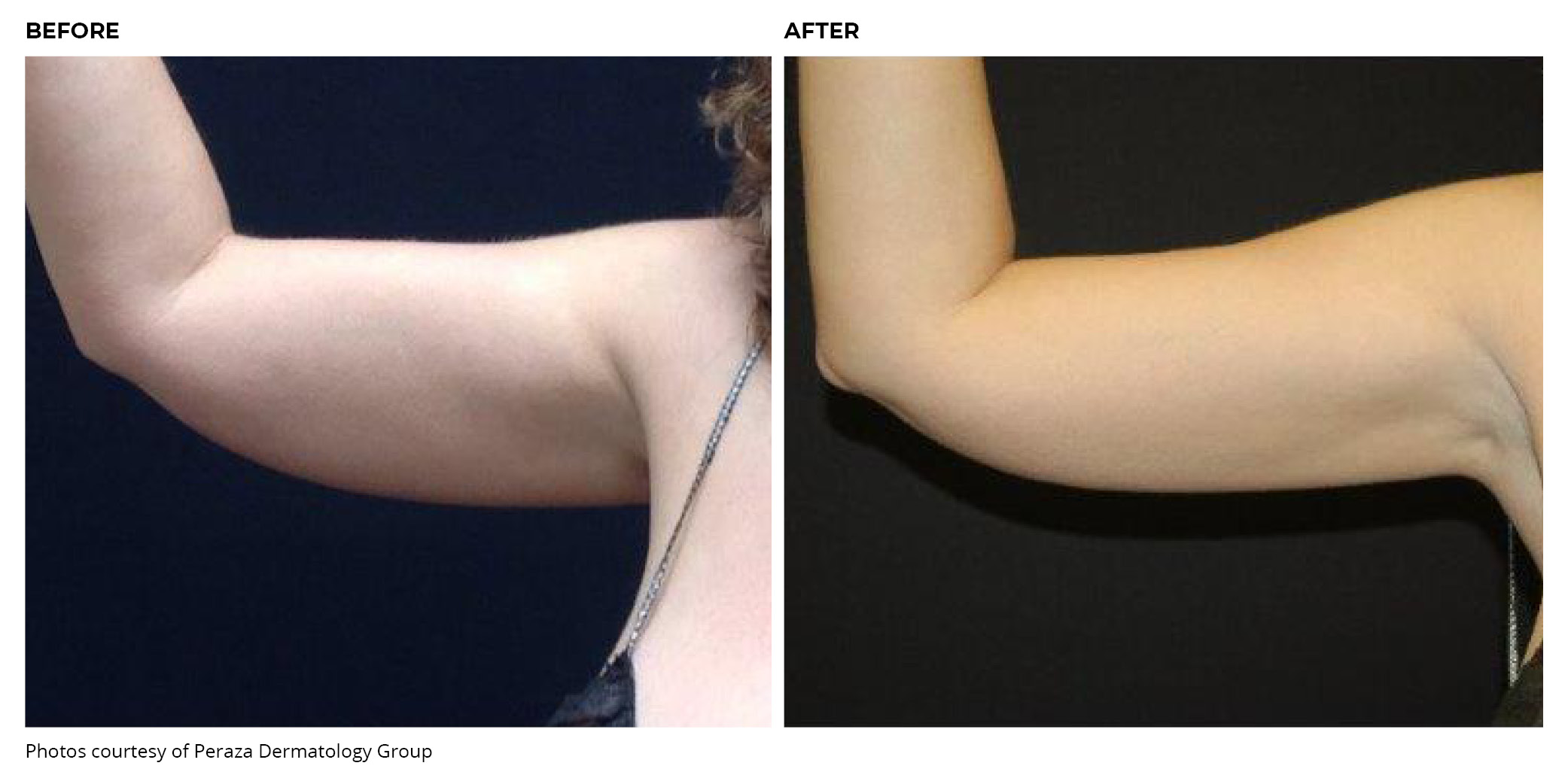 Coolsculpting® Before and After Arm