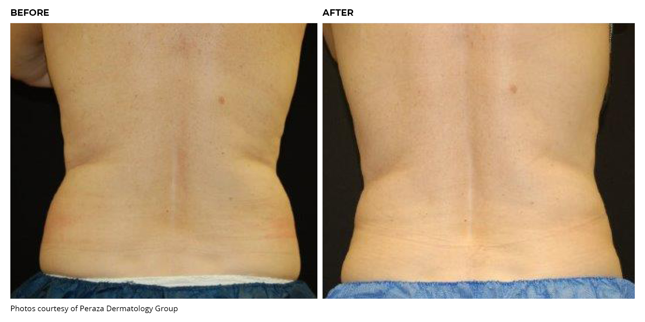 Coolsculpting® Before and After Back