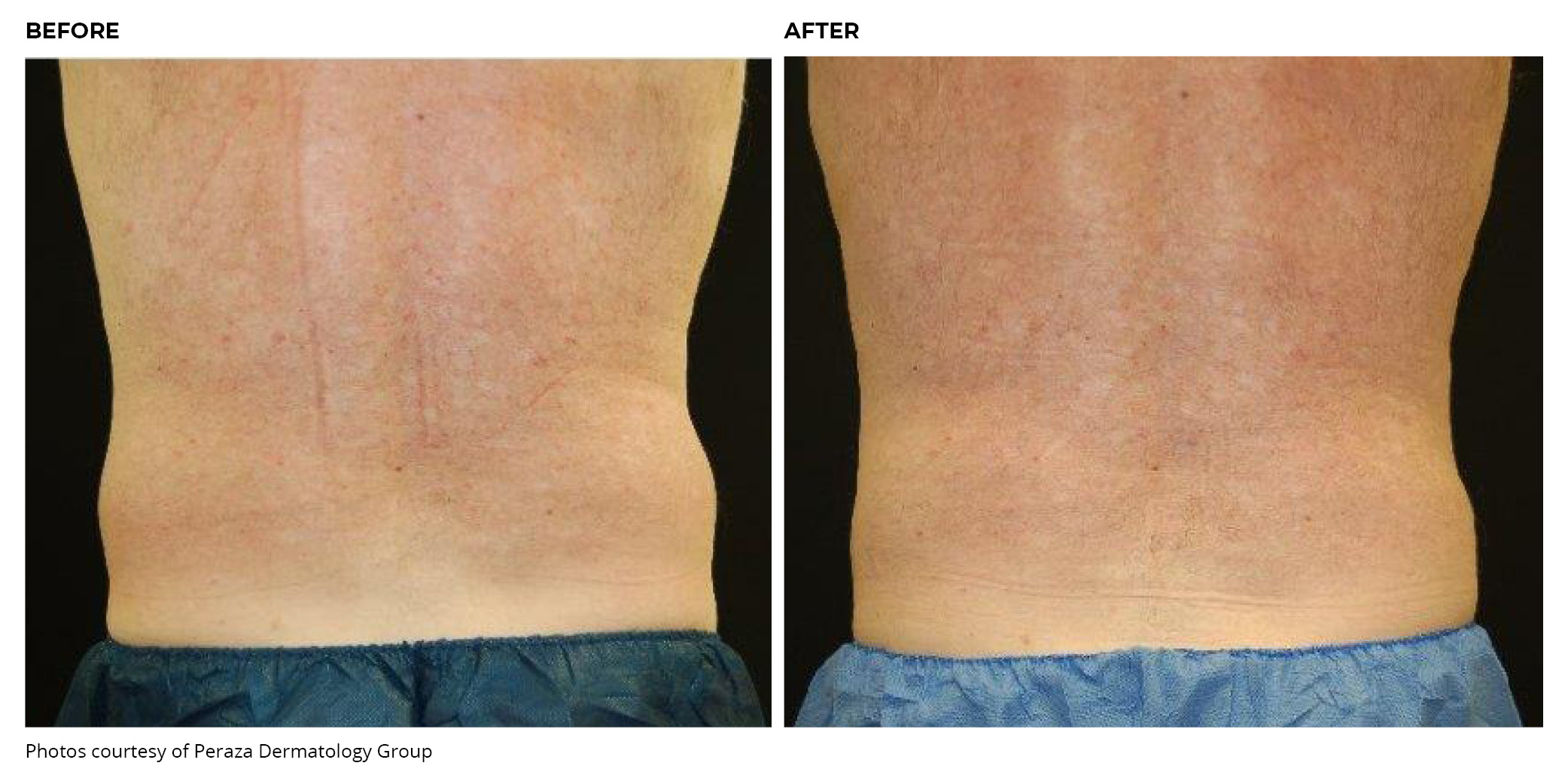 Coolsculpting® Before and After Back