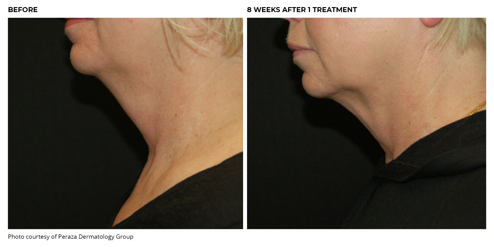 Coolsculpting® Before and After Chin