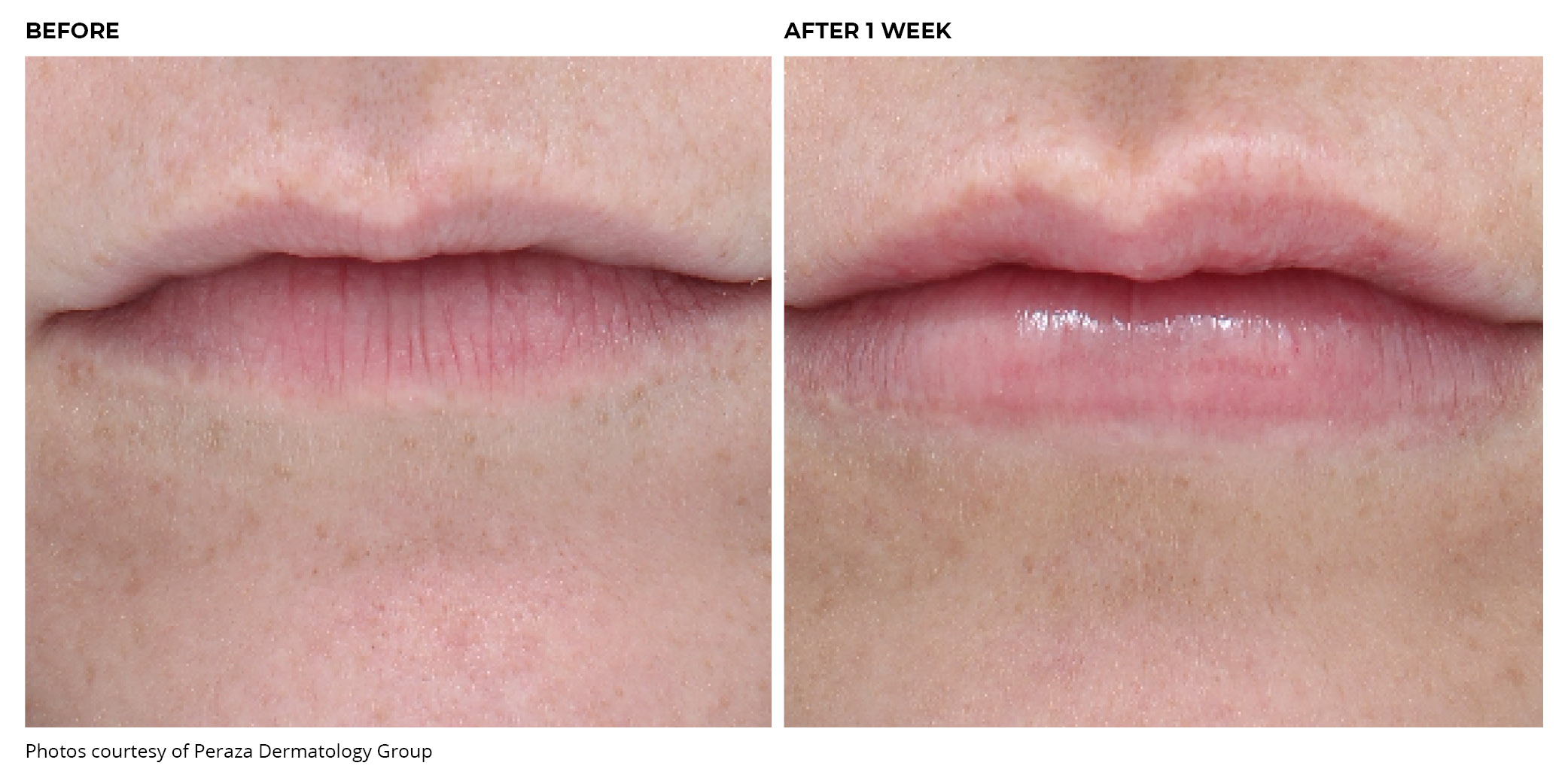 Juvederm Lips Before and After