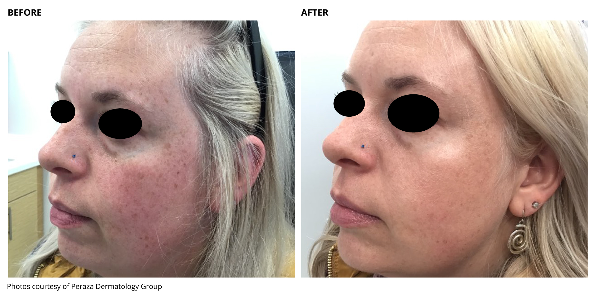 Lumecca IPL Before and After