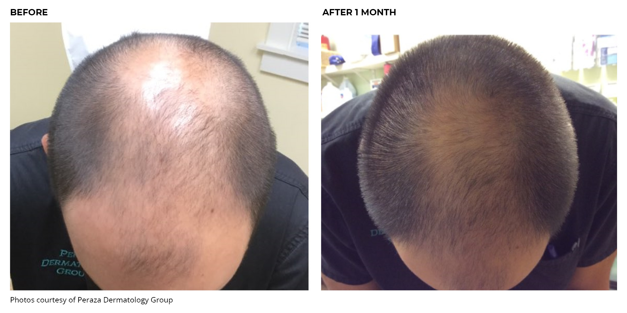 Platelet-Rich Plasma Before and After