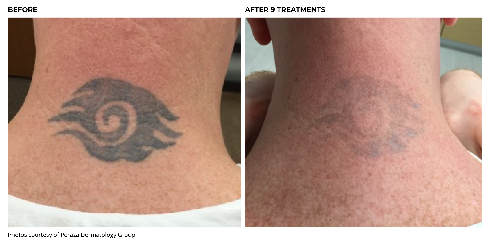 PiQo4 Tattoo Before and After