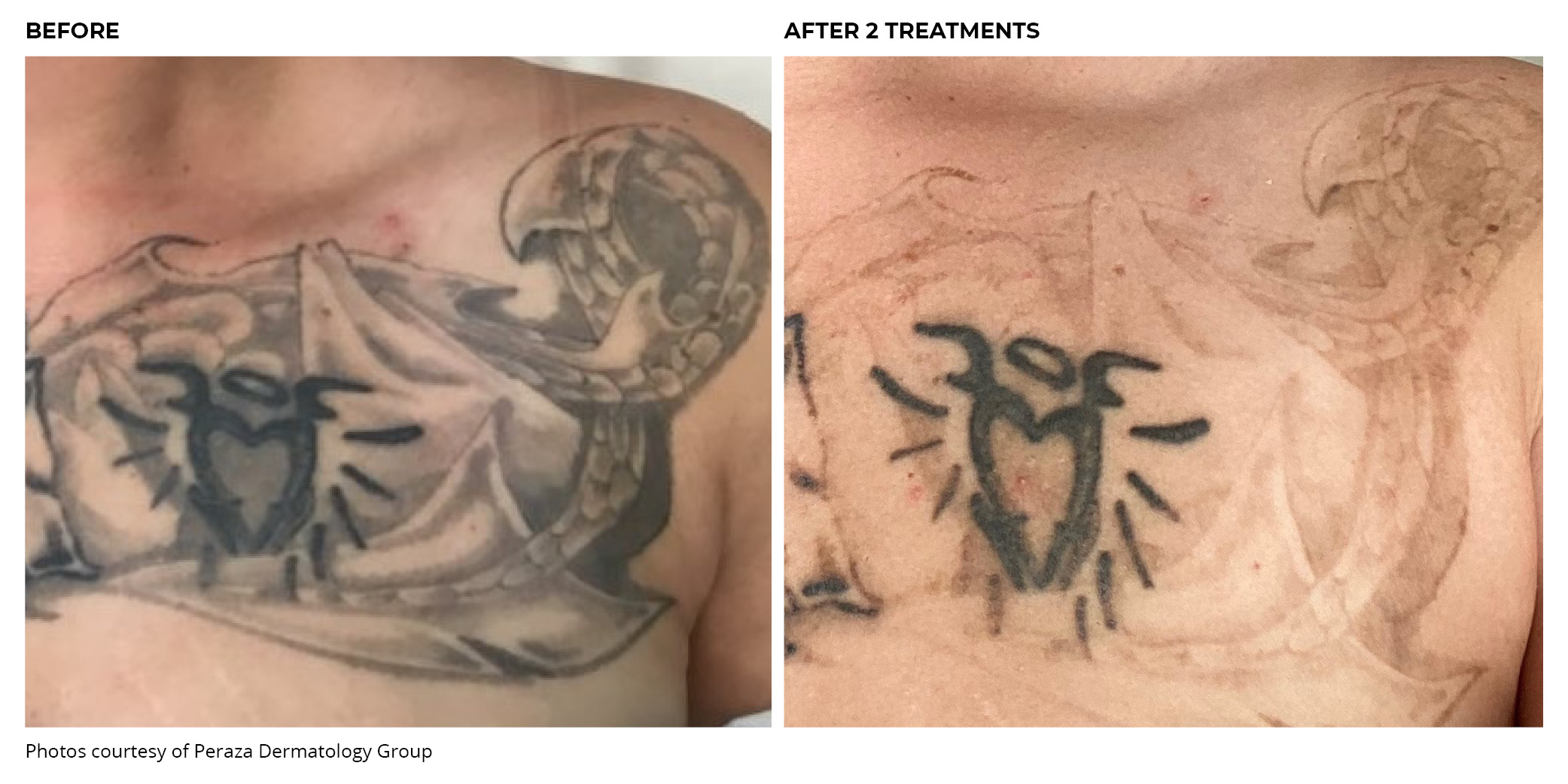 PiQo4 Tattoo Before and After