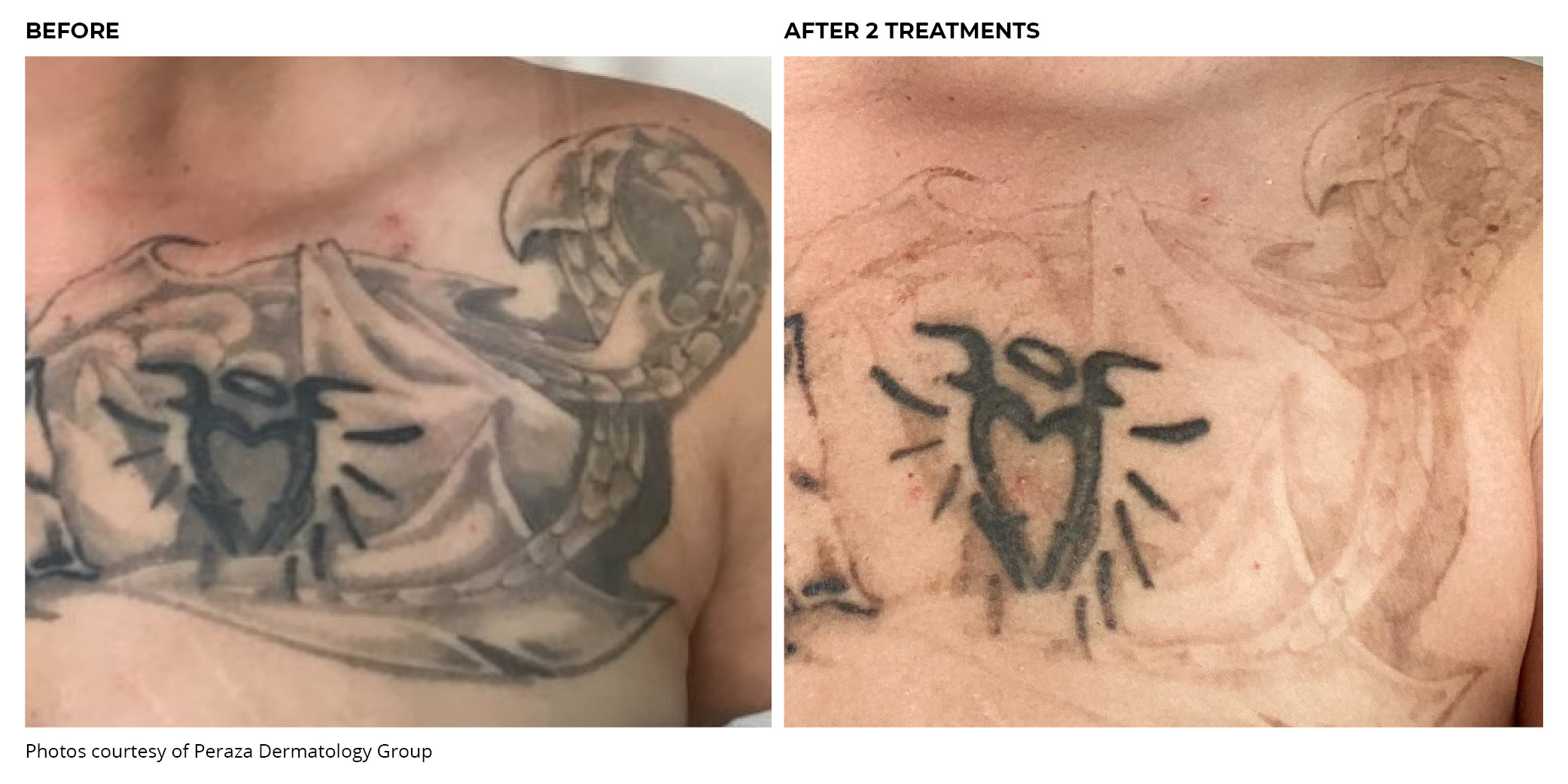 tattoo removal nj reviews