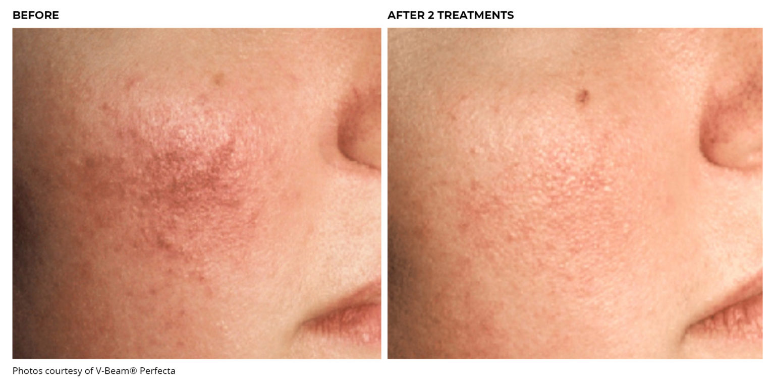 Laser Therapy for Unwanted Blood Vessels Peraza Dermatology Group