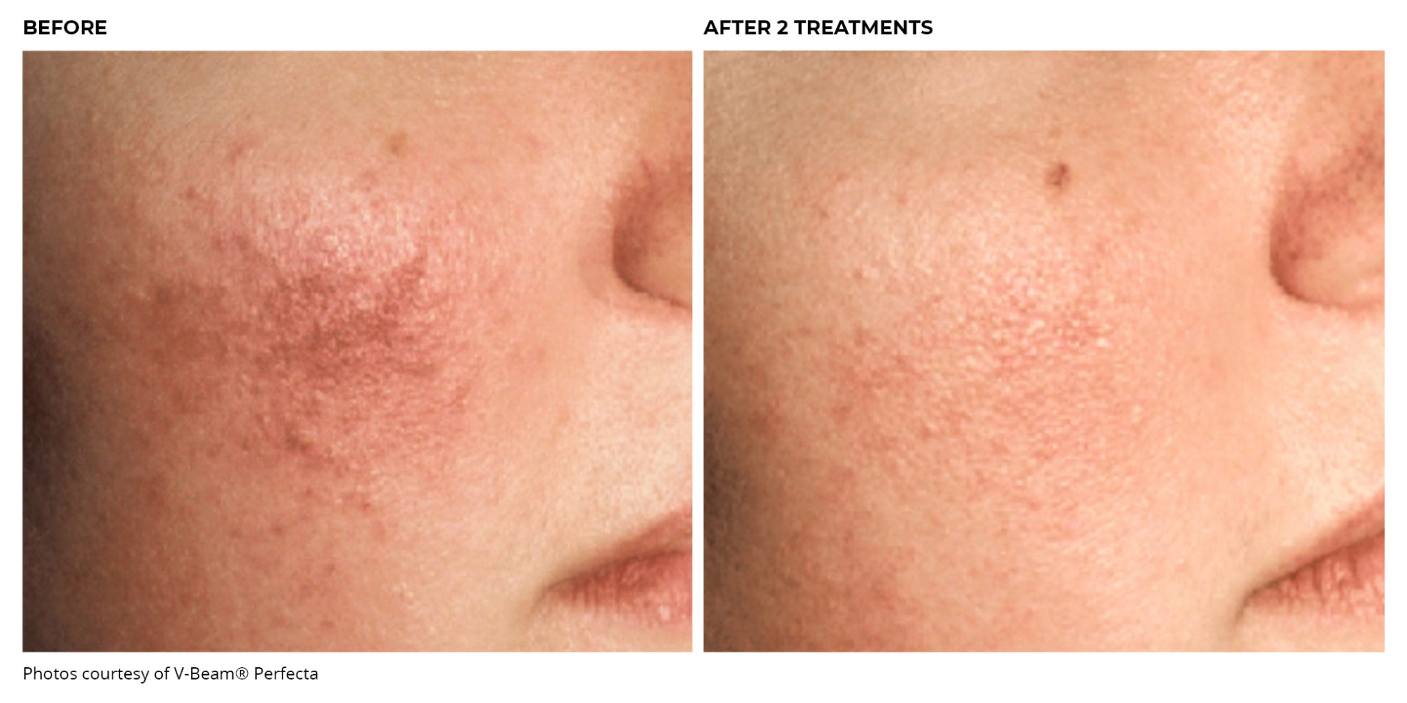 Laser Therapy for Unwanted Blood Vessels Peraza Dermatology Group